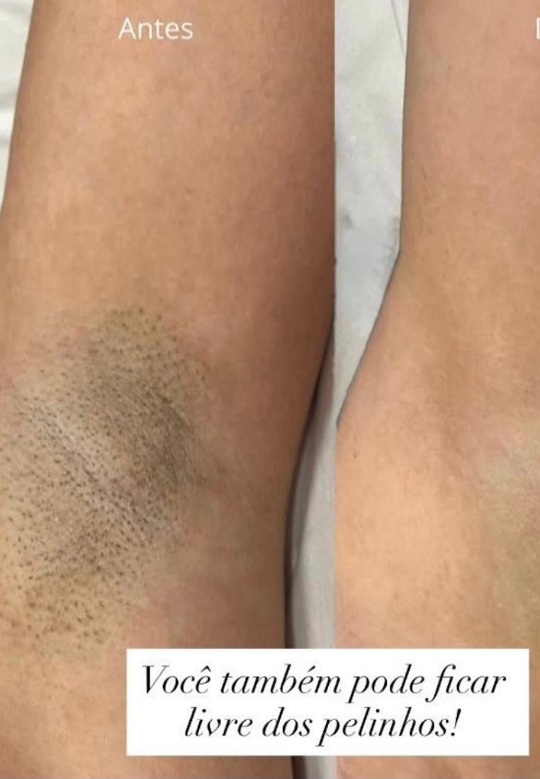 Spaço Clean Depilação a Laser 