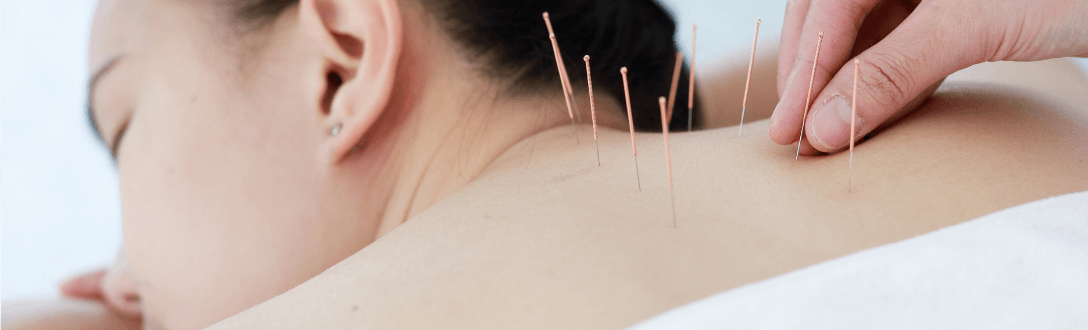 CNAE 8690-9/03 – Atividades de acupuntura: Simples Nacional, Fator R e abertura de empresa