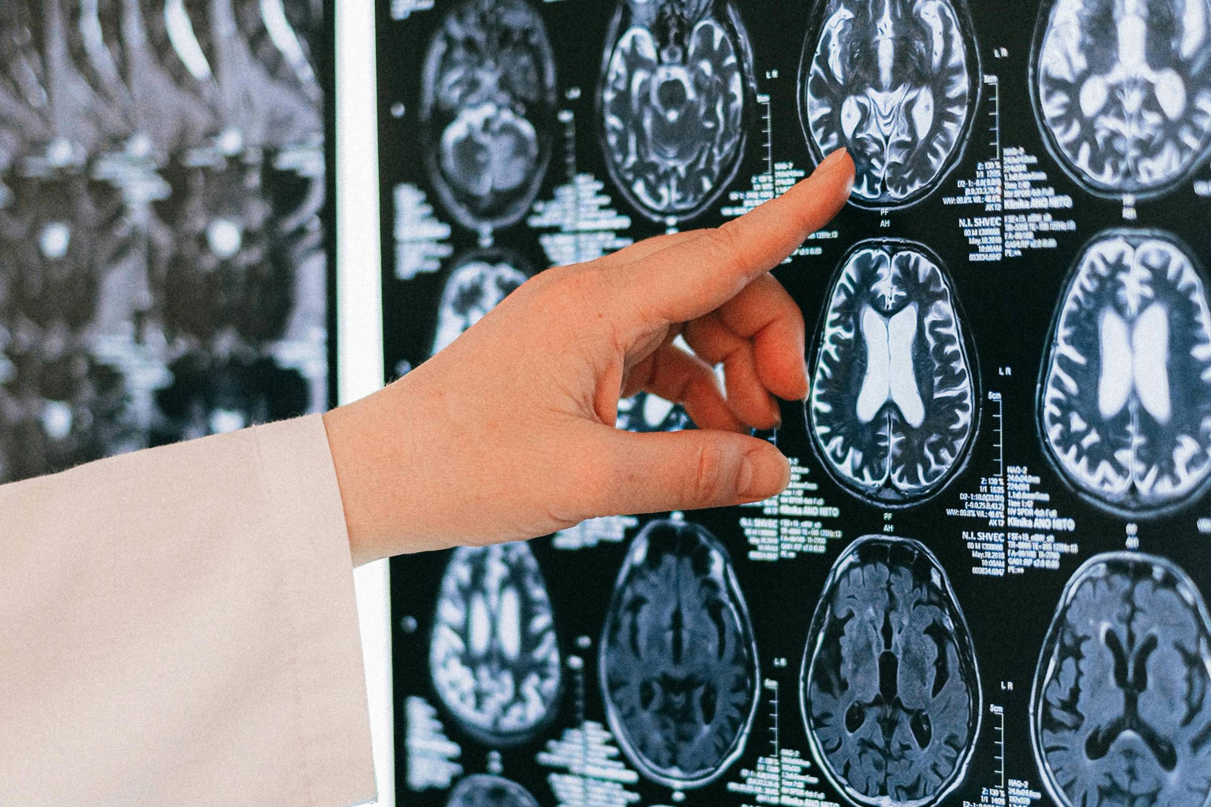 Pesquisa revela que estruturas cerebrais não causam psicopatia diretamente