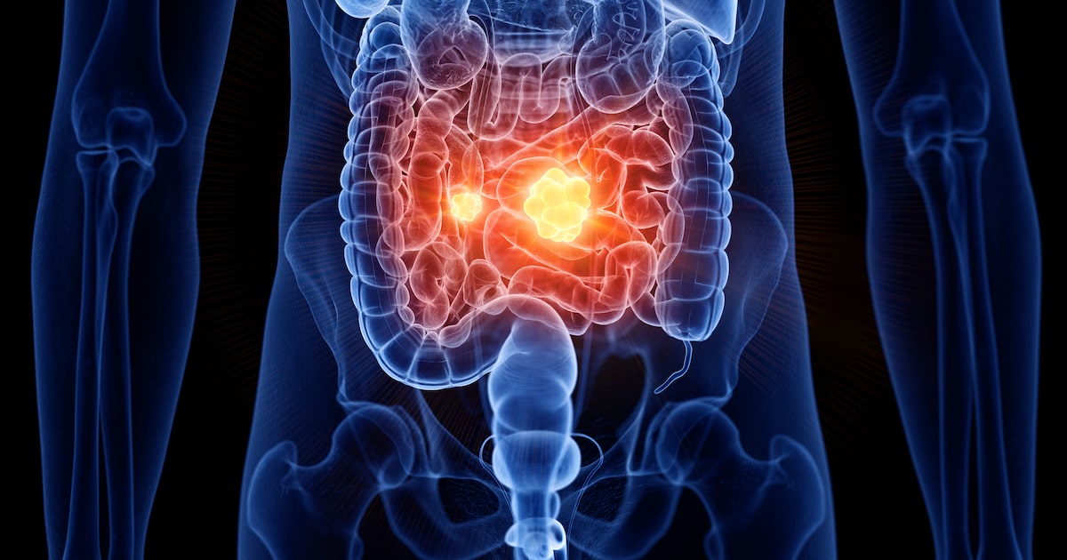 Diagnóstico de câncer de intestino está cada vez mais comum entre pessoas jovens (Foto: Sebastian Kaulitzki/Adobe Stock)