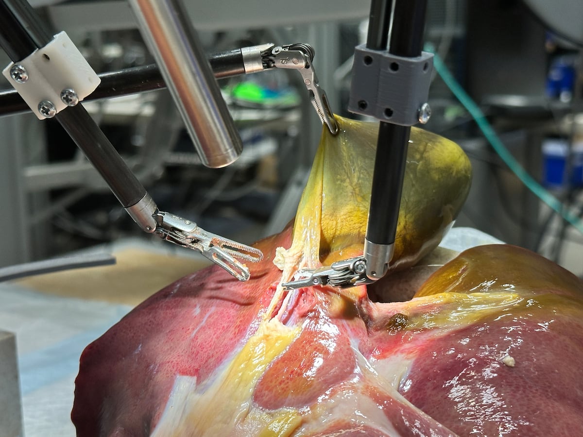 Máquina cirúrgica demonstra potencial para substituir cirurgiões humanos no futuro