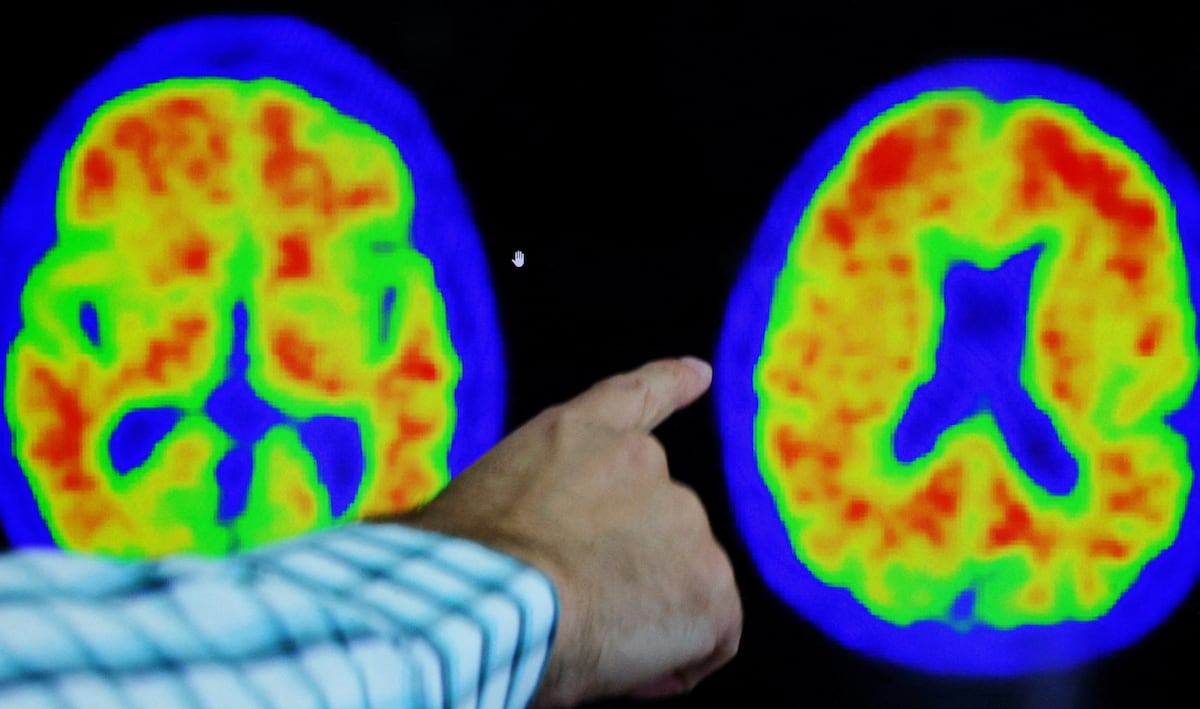 Cientistas criam mapa molecular que pode revolucionar tratamento do alzhéimer e parkinson