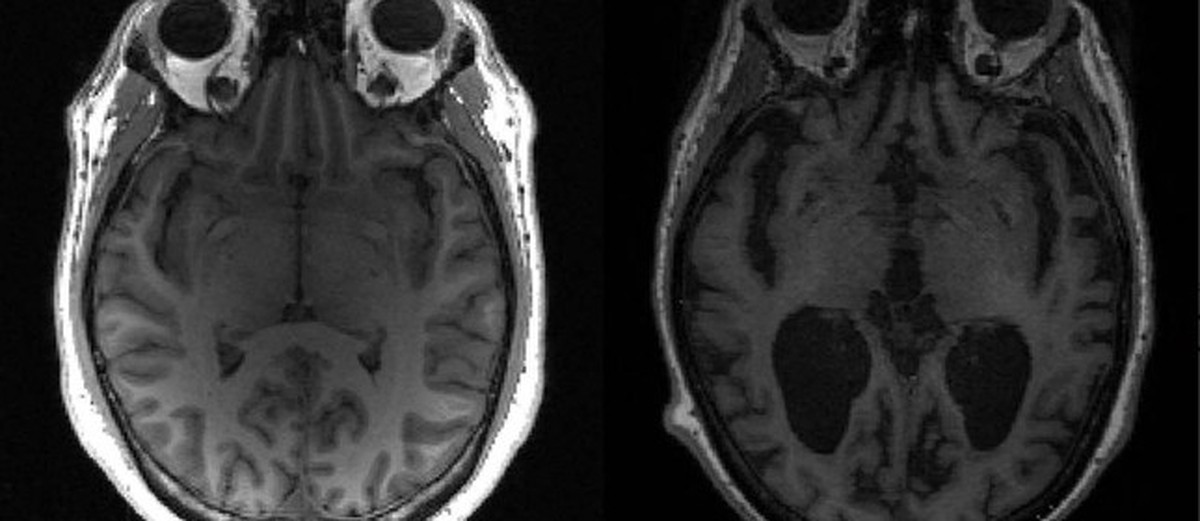 Remédio inovador contra Alzheimer avança para fase final de testes clínicos