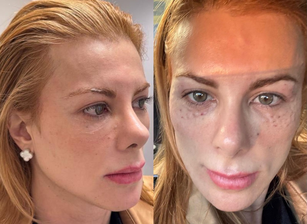 Deborah Albuquerque investe em tratamento com DNA de salmão para rejuvenescer as pálpebras. (Foto: Divulgação)