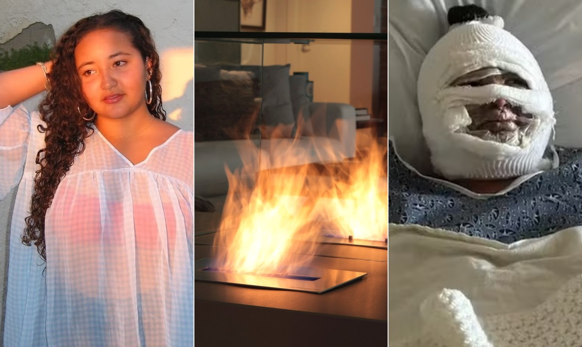 Lareira a álcool causa explosão e deixa jovem de 18 anos com o rosto desfigurado
