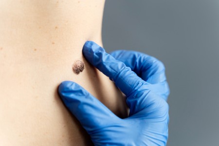 Genes identificados podem prever eficácia da imunoterapia em pacientes com melanoma