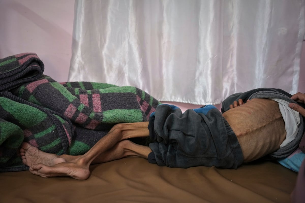 Um menino mostra claros sinais de desnutrição em um hospital da cidade gazatí de Jan Yunis, em 1 de maio. (Foto: Abdel Kareem Hana/AP)