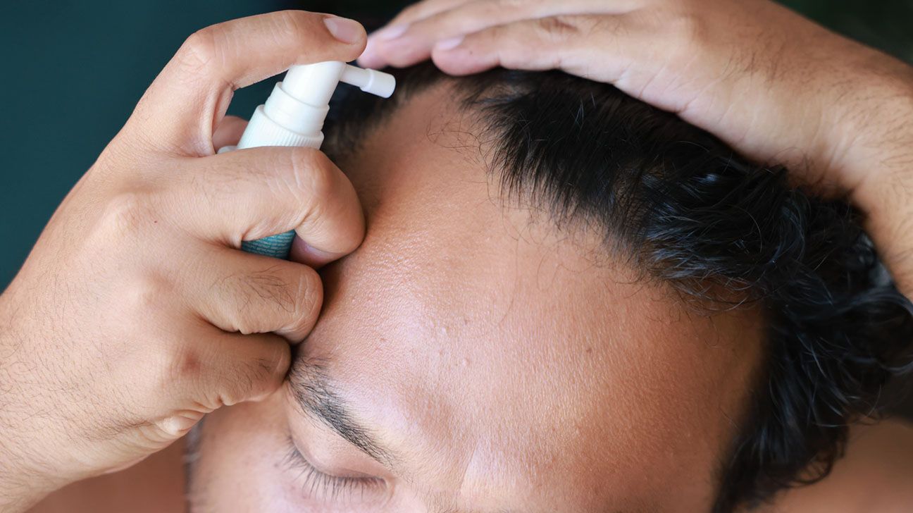 A FDA ainda não aprovou o uso de finasterida tópica para tratar a queda de cabelo, um tratamento popular vendido por empresas de telemedicina. (Foto: Narongrit Doungmanee/Getty Images)