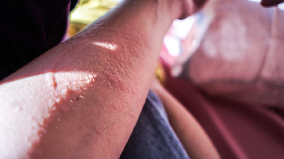 Entenda a alergia ao sol no verão e descubra como tratá-la efetivamente