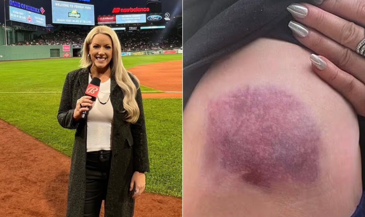 Bola de beisebol atinge repórter em campo e causa hematoma; veja o momento
