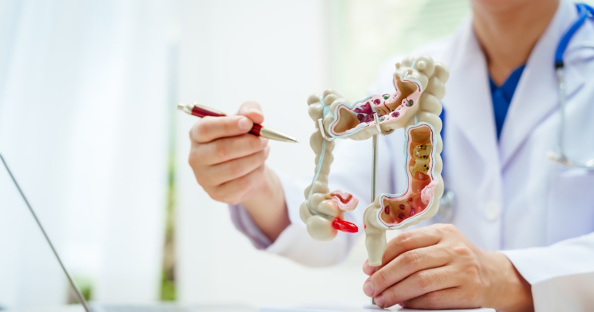 Teste acessível identifica câncer de intestino em novos casos; saiba mais