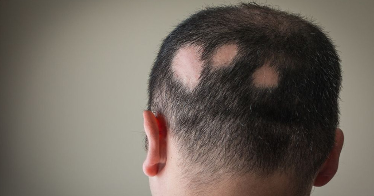 Alopecia areata gera debates sobre a necessidade de diretrizes mais eficazes
