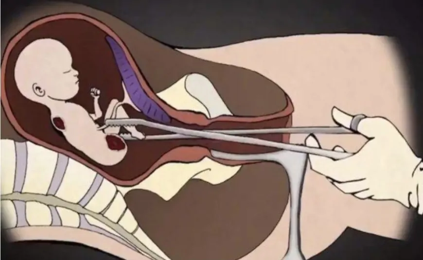 Esquerda recorre ao STF para garantir aborto até o 9° mês de gestação