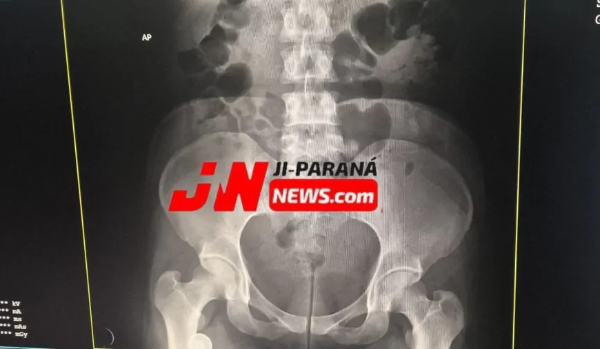 Mulher afirma ter escondido droga em órgão genital e mobiliza Polícia Militar