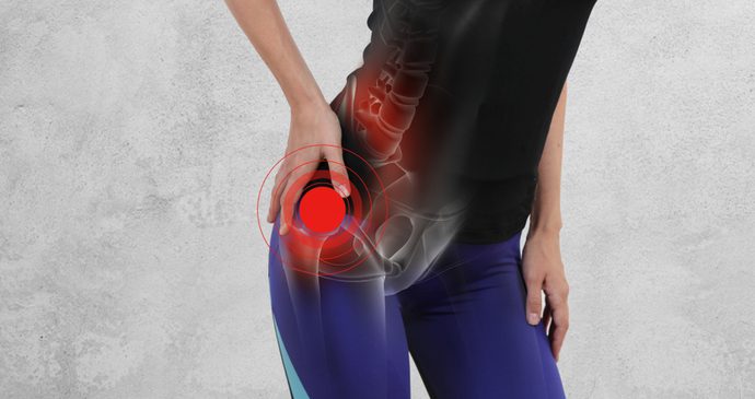 Bursite no quadril atinge principalmente mulheres e atletas. Saiba como se prevenir!