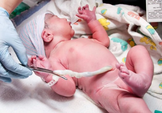 Nacimiento de un bebé y recolección de sangre del cordón umbilical para donación.